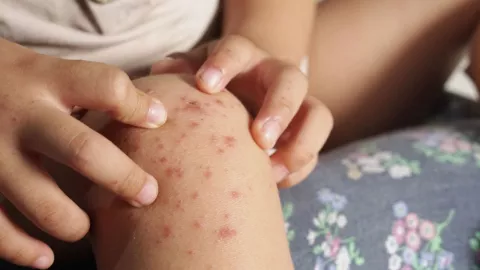 Qué es el virus coxsackie y cómo se contagia