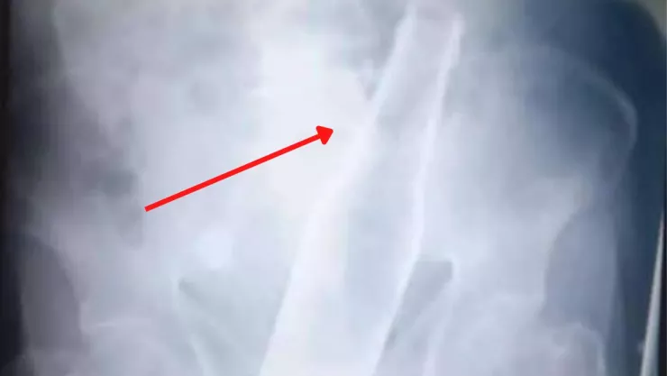 Fue al hospital por dolor; hallaron una botella atorada en el colon