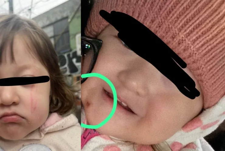 Madre comparte fotos de la evidencia del abuso sexual que sufrió su pequeña hija de casi dos años en una guardería de la CDMX.