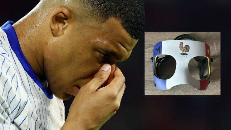 Kylian Mbappé sufrió una lesión en la nariz el 17 de junio.