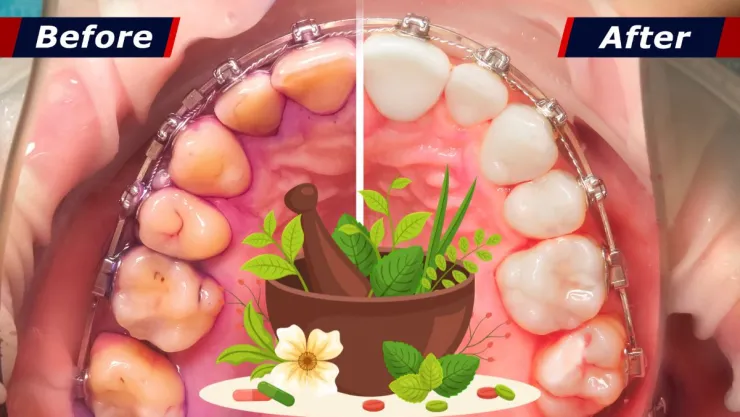 ¡Elimina el sarro de tu sonrisa! Esta solución casera limpia tus dientes