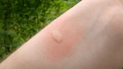 Picadura de mosquito