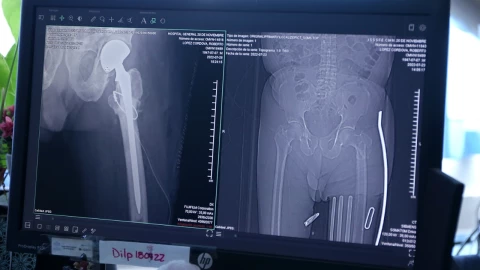 ISSSTE Paciente de 75 años vuelve a caminar gracias a prótesis