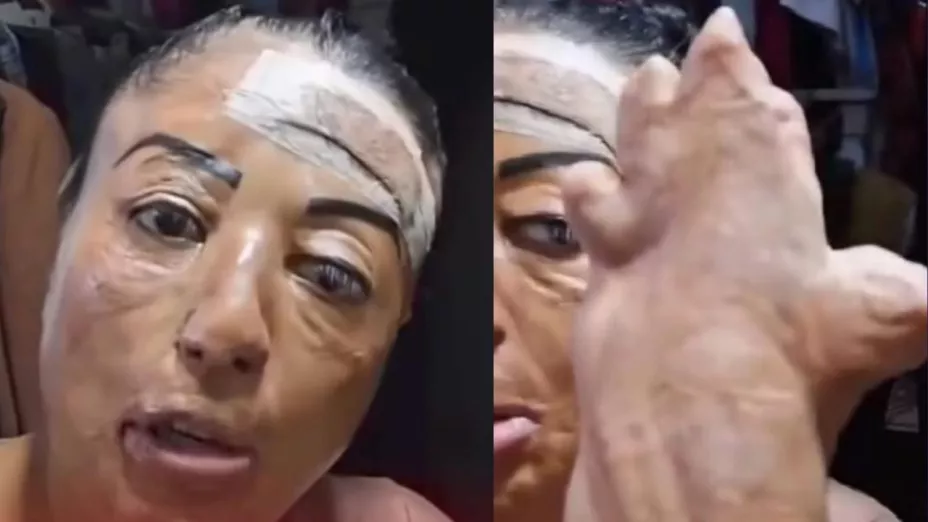 Joven casi muere al explotarle su celular que dejó cargando en almohada.jpg