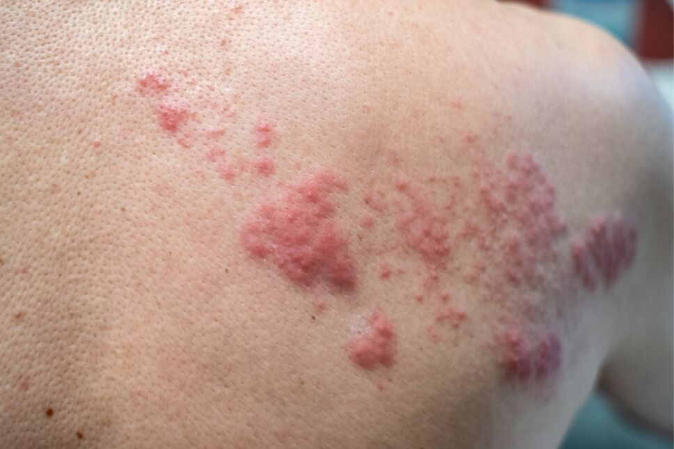 espalda con herpes zoster culebrilla