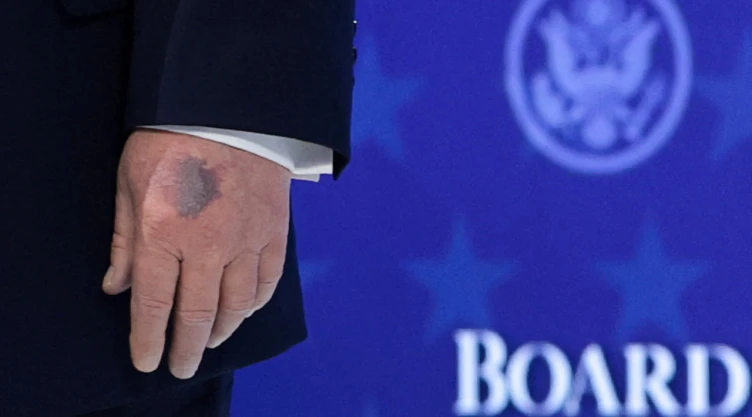 La mano magullada del presidente de Estados Unidos , Donald Trump , mientras asiste a un anuncio de la carta constitutiva de su iniciativa Junta de Paz destinada a resolver conflictos globales, junto con el 56º Foro Económico Mundial anual (FEM), en Davos, Suiza, el 22 de enero de 2026.