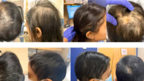 picadura de garrapata hace que mujer pierda su cabello