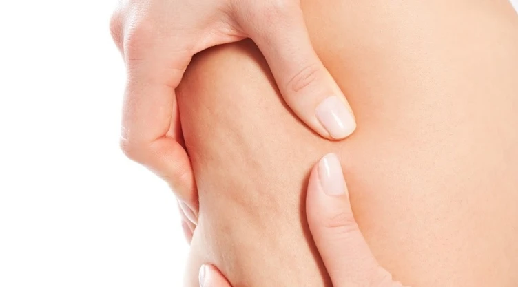 Tener una dieta balanceada y equilibrada puede ayudar a prevenir la celulitis/ Foto: Especial