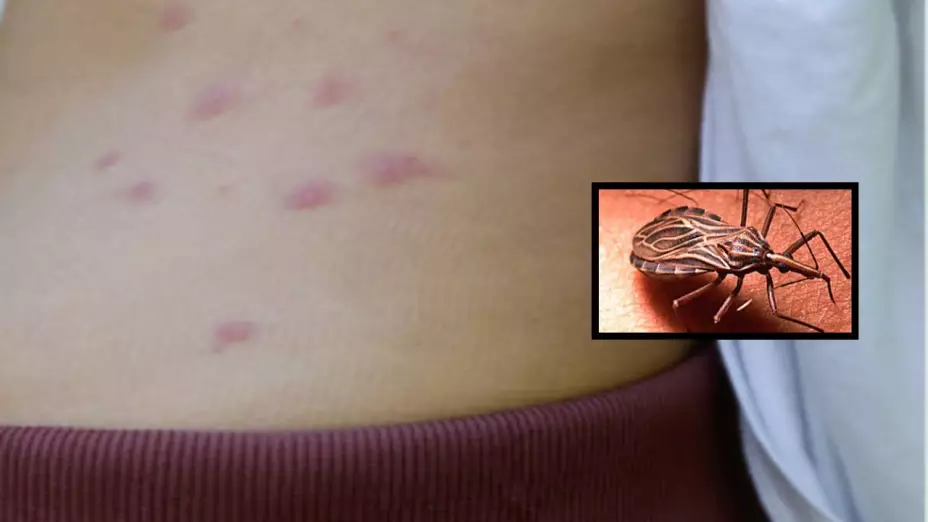 Enfermedad de Chagas: recomendaciones clave de especialistas