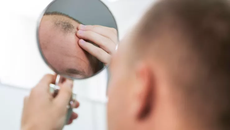 Científicos de UCLA prueban crema que reactiva el crecimiento capilar en personas con alopecia