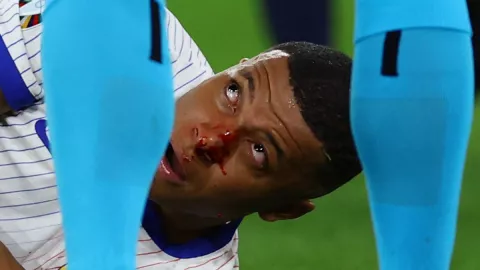 Kylian Mbappé sangrando de la nariz