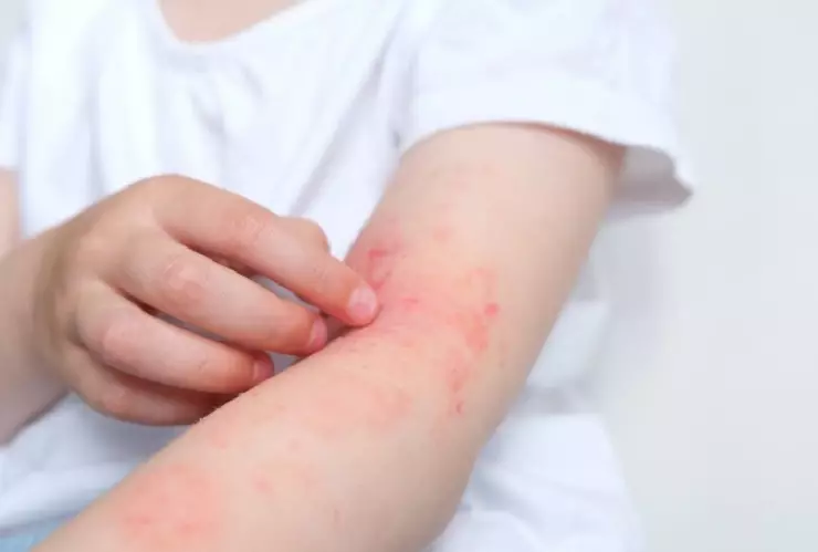 Sarampión_ ¿Cuántas veces te puede dar en la vida