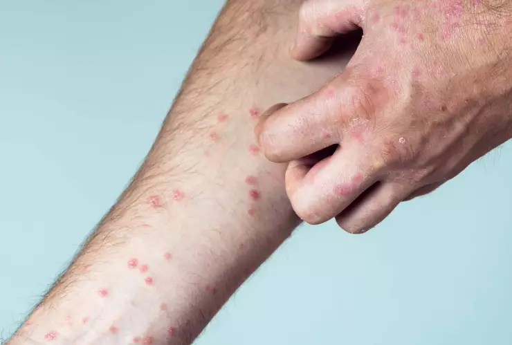 Dan de alta a último paciente de Sarampión