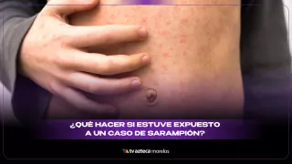 ¿Qué hacer si estuve expuesto a un caso de sarampión? - ALEXIS BALBUENA.jpg