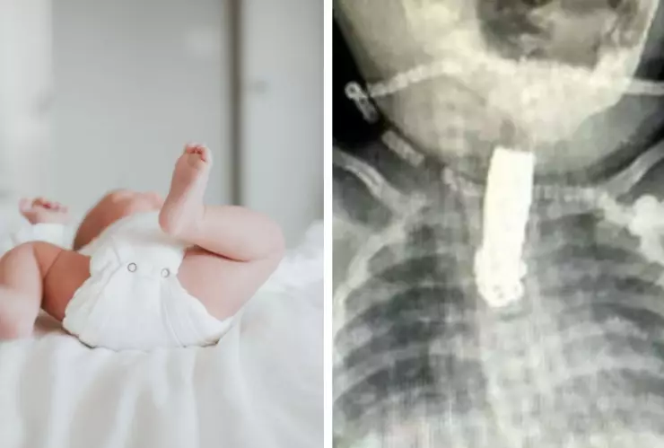 FOTOS Una bebé se traga un cortauñas y se le atora en la garganta