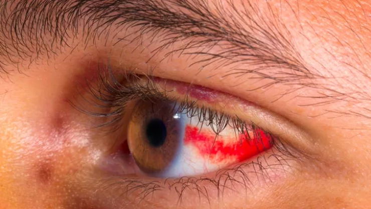 Una mujer comenzó a secretar sangre por los ojos durante su periodo menstrual y sorprendió a médicos