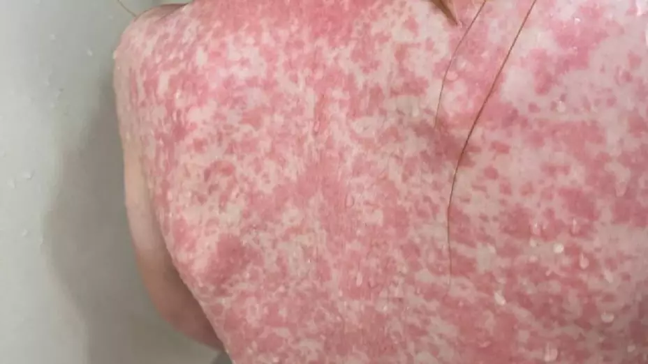 Sarampión en Guerrero