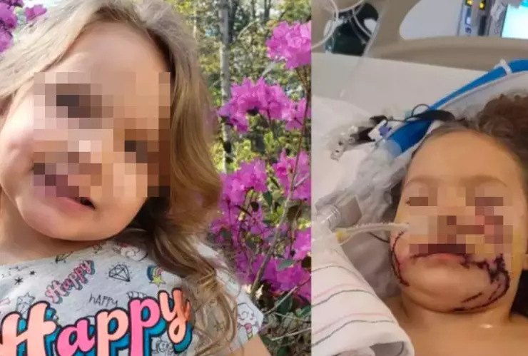 Niña no volverá a sonreír luego de que pitbull le destrozó la cara