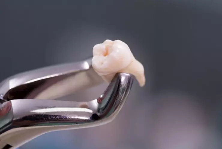 Extracción de dientes de leche