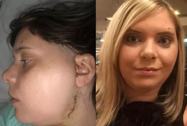 hamburguesa cirugia mandibula.jpg