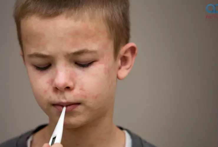 Especialista: Personas con sarampión podrían perder la audición