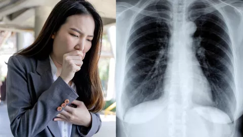 Mujer tose tan fuerte que se rompe cuatro costillas