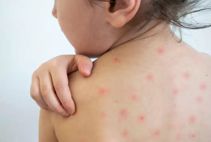 sarampión en Chihuahua