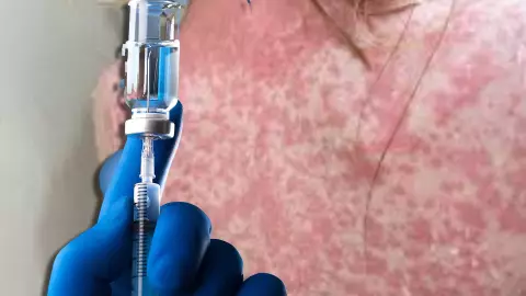 ¿A qué edad se aplica la vacuna para el sarampión? Lo que debes saber sobre la dosis