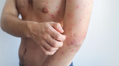 Lo que no sabías del sarampión.