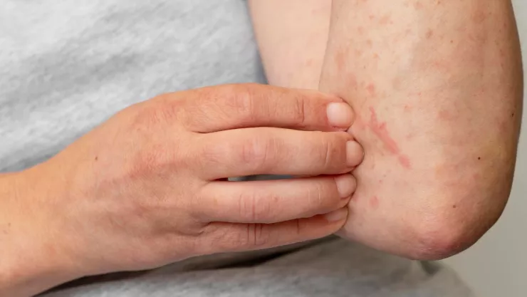 Muerte en India por viruela de mono