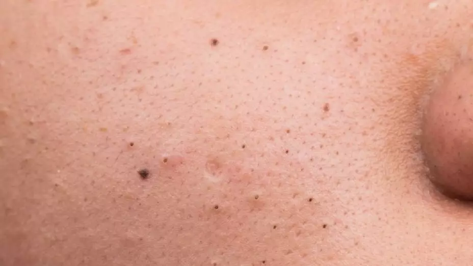 ¿Te gusta ver video de granos, padeces de Forunculofilia