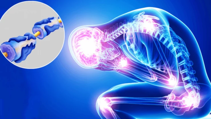 sindrome de guillian barre sintomas