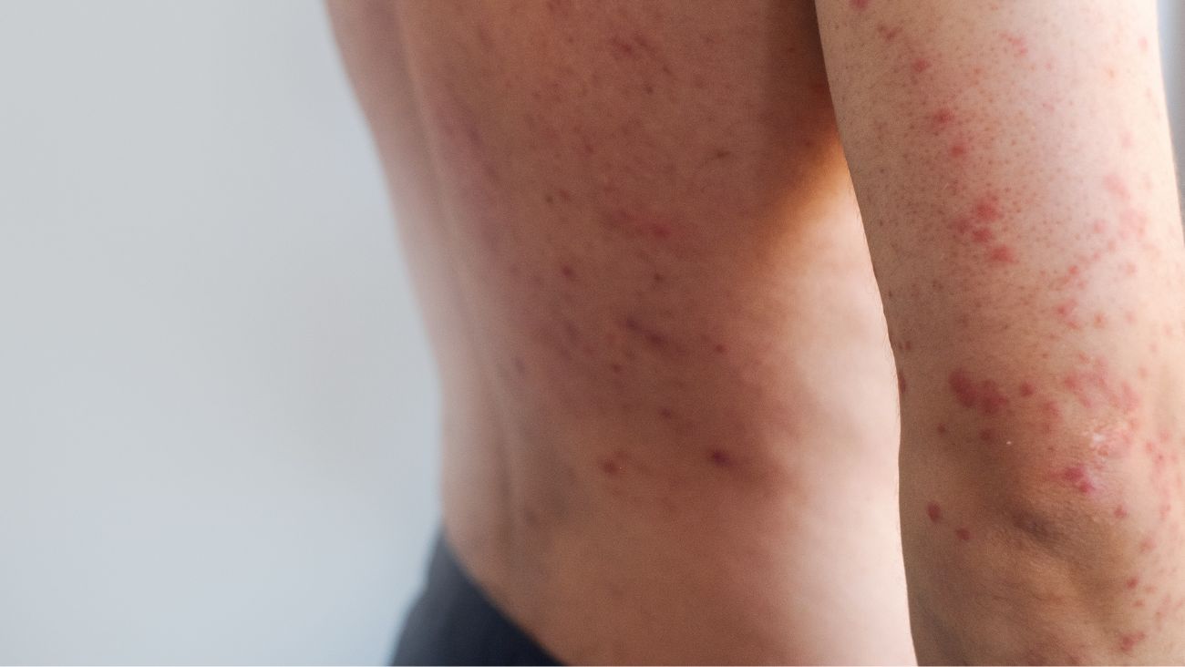 COVID-19 o sarampión, la enfermedad que es más contagiosa